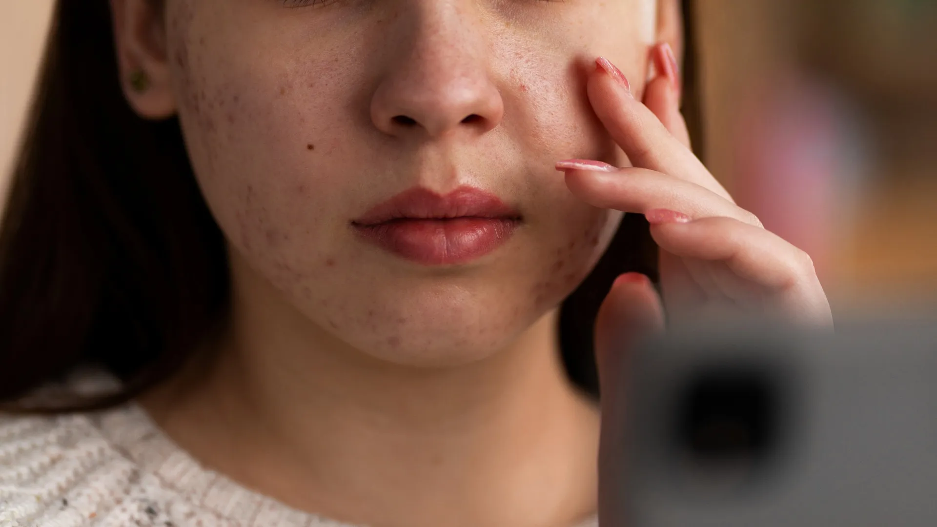 Acné : pourquoi elle apparaît et ce que dit vraiment votre peau ?