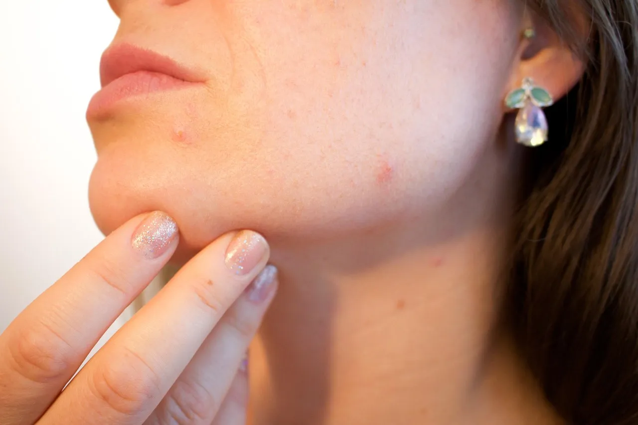Traitement des boutons d’acné : solutions efficaces pour une peau nette